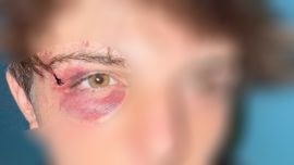 happygaytv: Paul, 17, victim of a homophobic attack